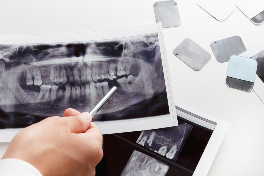 Dentist shows the X-ray dental problem scan